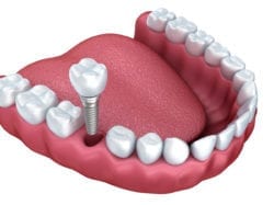 single tooth implants riverhead ny