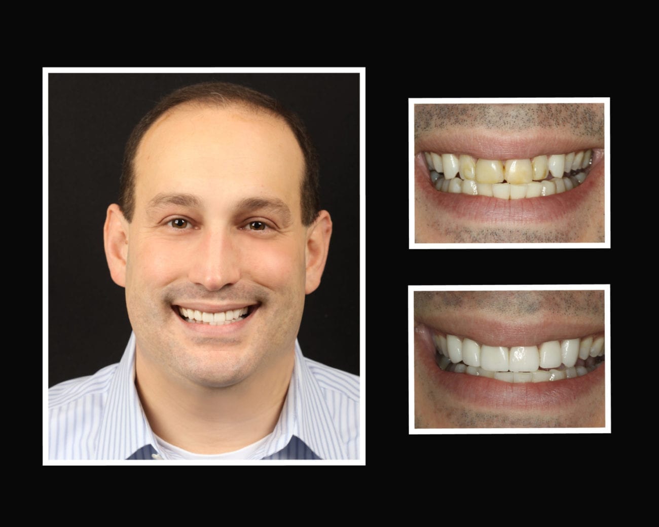 Teeth Bonding Riverhead, Roslyn, Nesconset NY