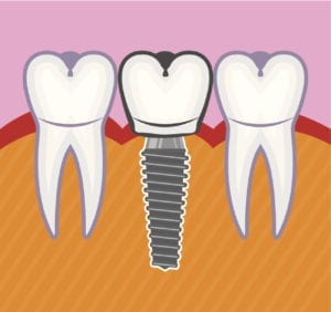 dental implants in Riverhead, Roslyn, Nesconset