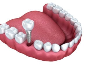 Single tooth implant in Roslyn, NY