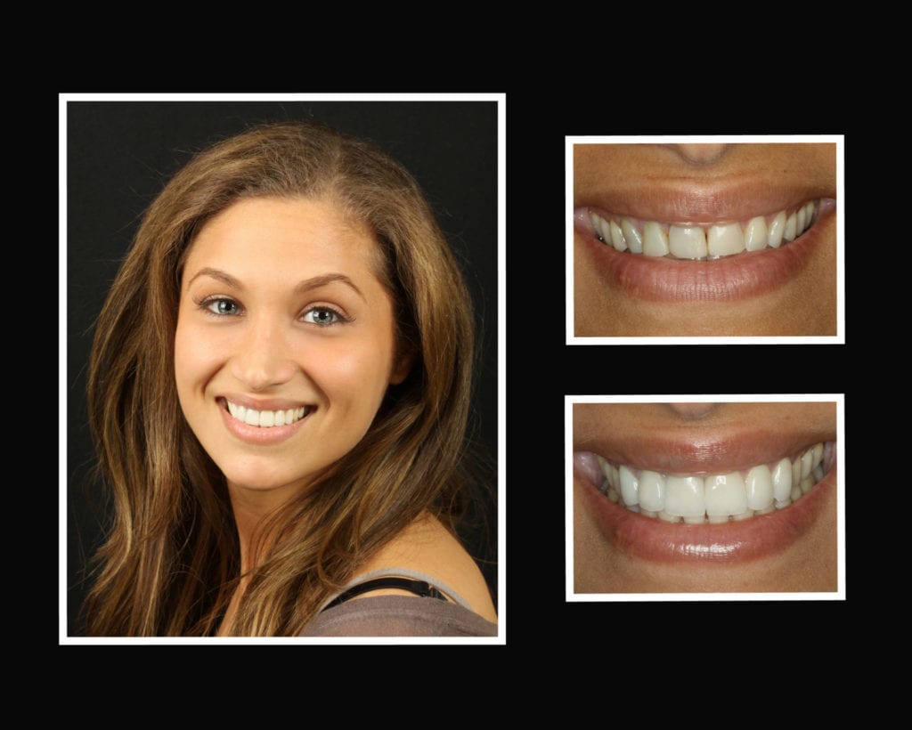 porcelain veneers in Long Island New York