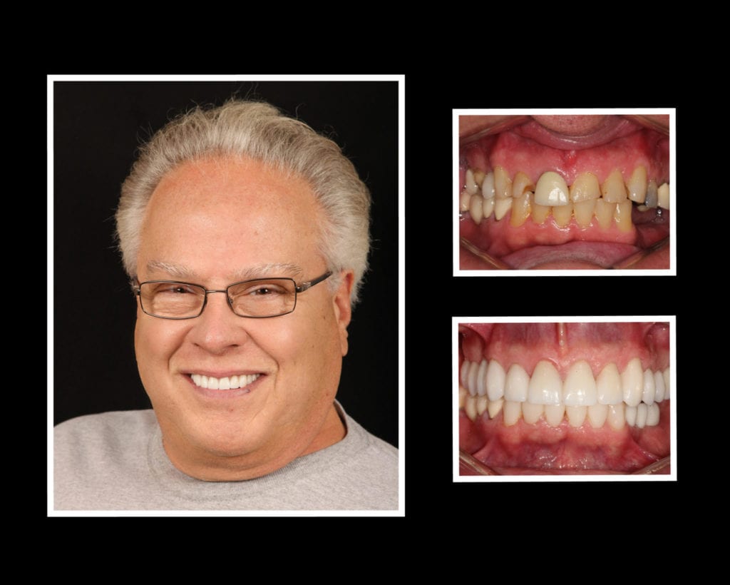 restorative dentist long island patient before and after photos