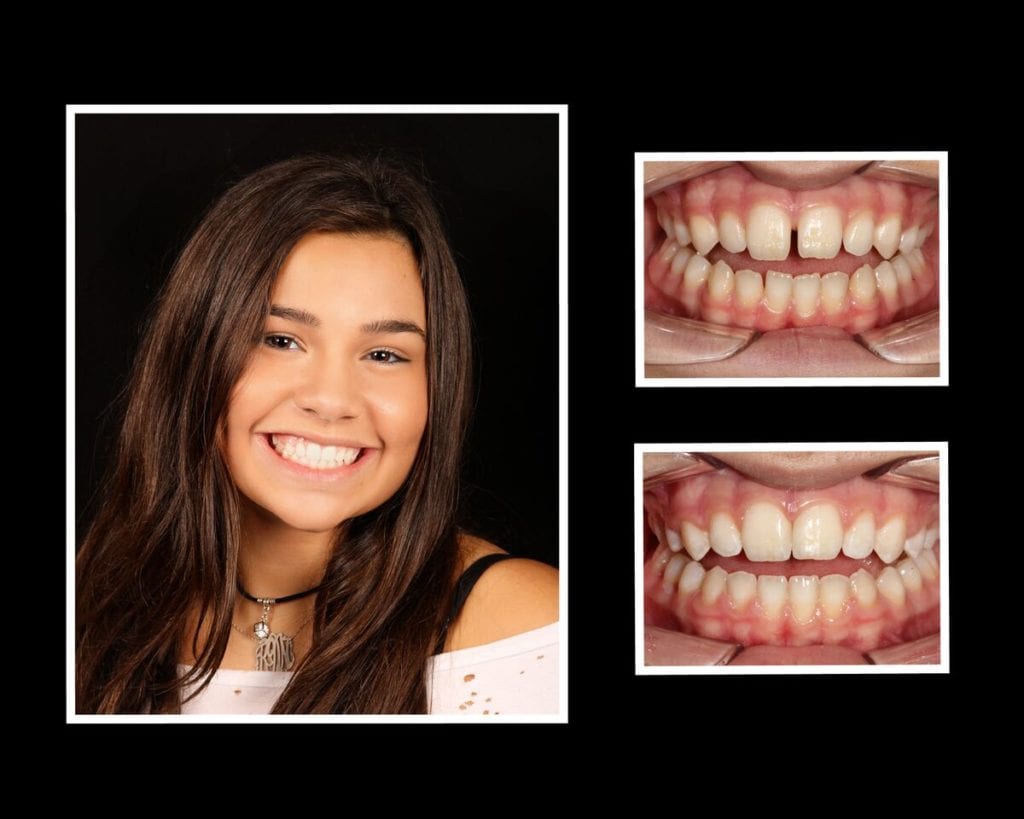 Invisalign patient before and after photo in Riverhead New York