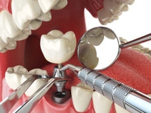 dental implants in Roslyn New York