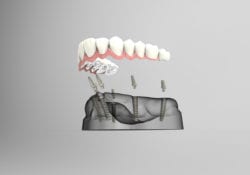 dental implants glen head ny