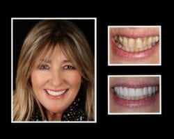 Porcelain Veneers