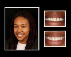 Smile Makeover