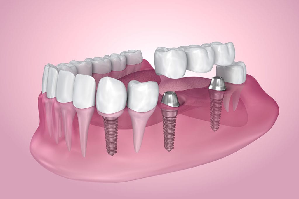 Bella Smiles offers dental implants in Riverhead and Roslyn, NY