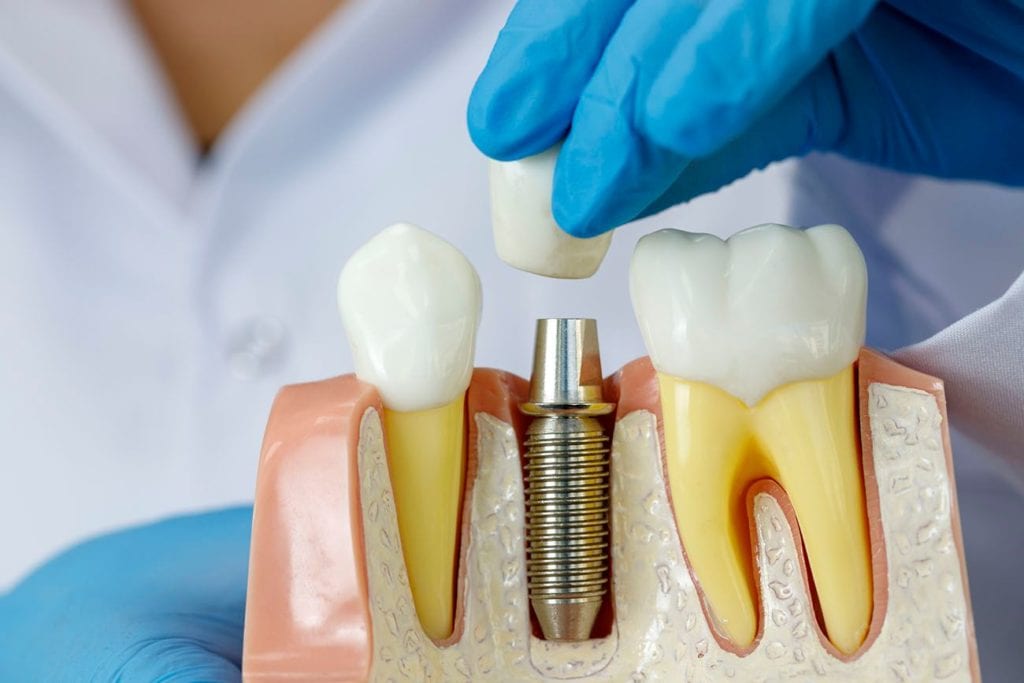 Dental Implants in Nesconset NY