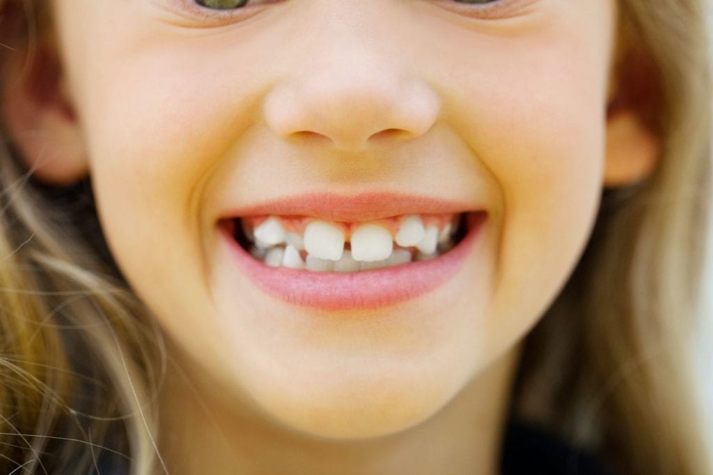 Should My Child Get Invisalign or Braces in Long Island NY