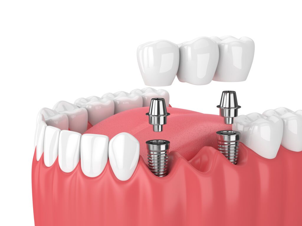Dental implant-supported bridges in Roslyn
