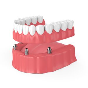 Implant-supported denture in Roslyn, NY
