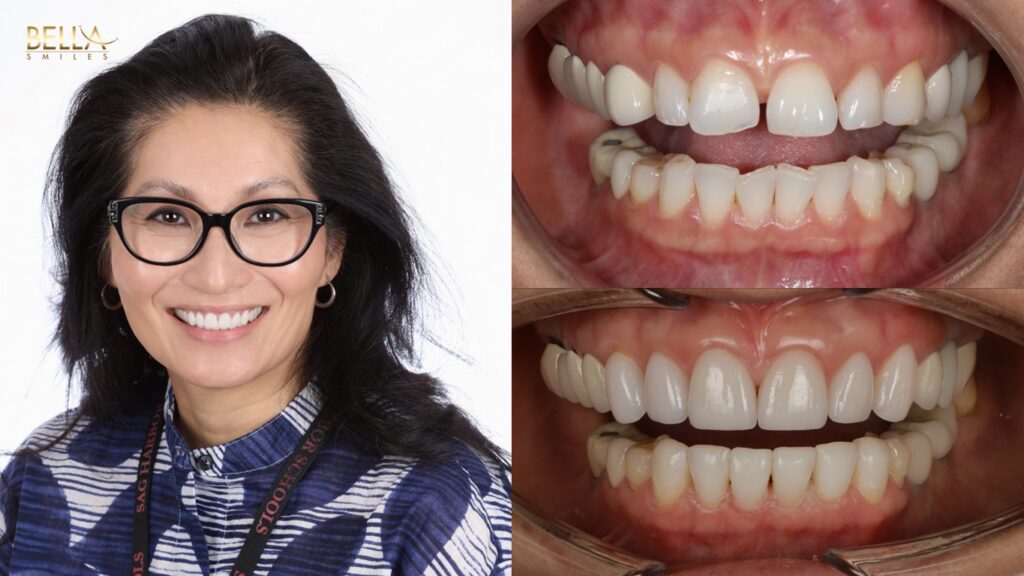 Dental patient before and after procedure