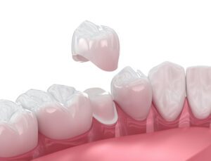 7 Signs Your Dental Crown Needs Replacing in Nesconset, NY