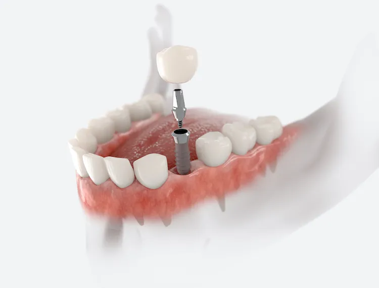 Dental Implants Under one Roof Roslyn NY