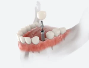 Dental Implants 101 in Riverhead, NY