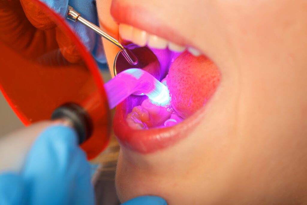 Tooth Bonding in Nesconset, Riverhead, and Roslyn NY