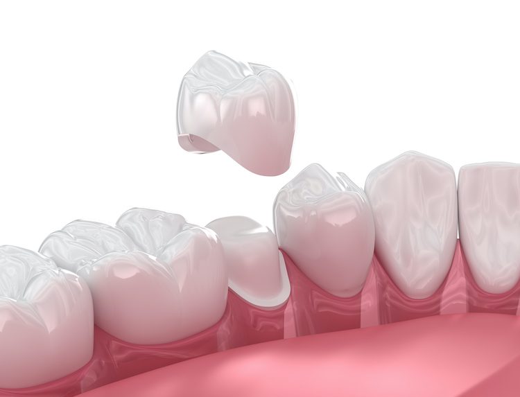 Replace Dental Crowns Riverhead Roslyn Nesconset