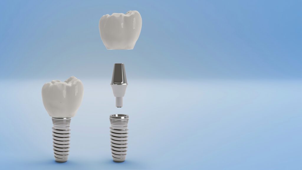 Dental Implants Roslyn NY