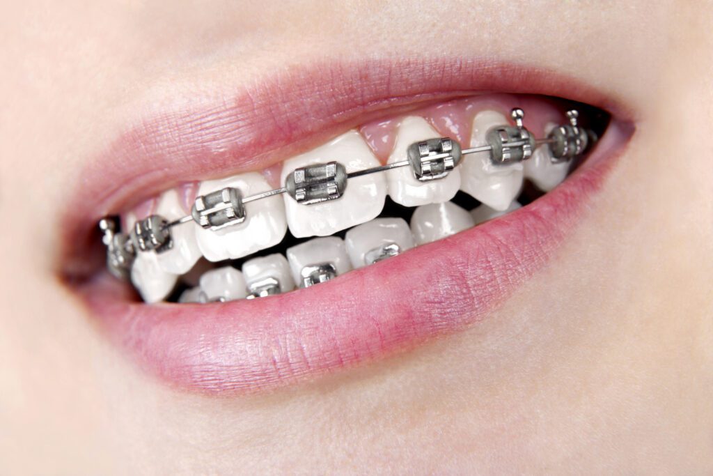 When Should My Teen Start Orthodontics?